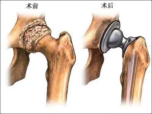 關節(jié)置換