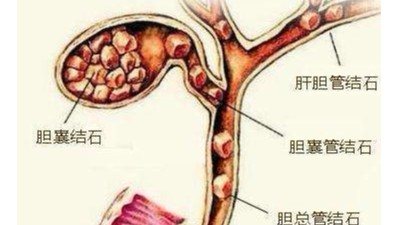 膽囊結(jié)石可以不切膽嗎？