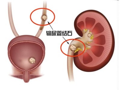 輸尿管結(jié)石